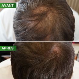 Dermaroller BBHair Densité pro 100 ml